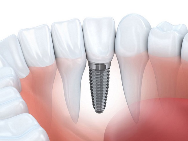 Top 12 địa chỉ trồng răng implant tại TPHCM tốt nhất